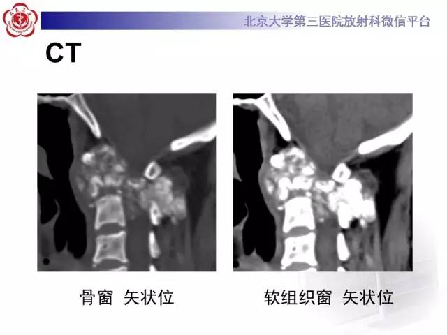 【病例】颈椎骨肉瘤1例CT及MR影像表现