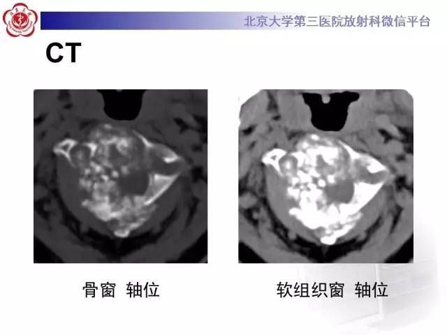 【病例】颈椎骨肉瘤1例CT及MR影像表现