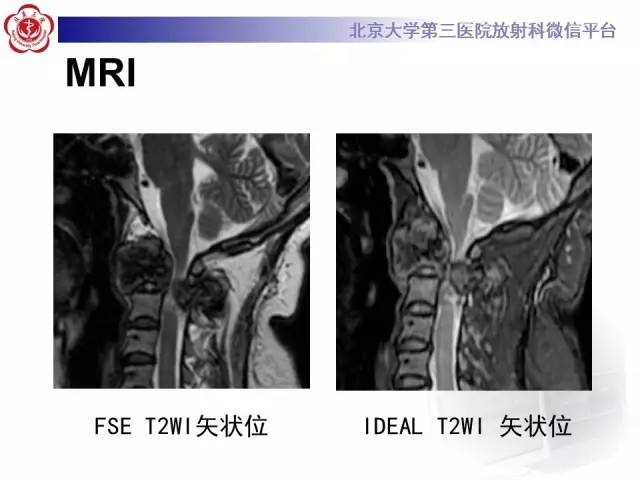 【病例】颈椎骨肉瘤1例CT及MR影像表现