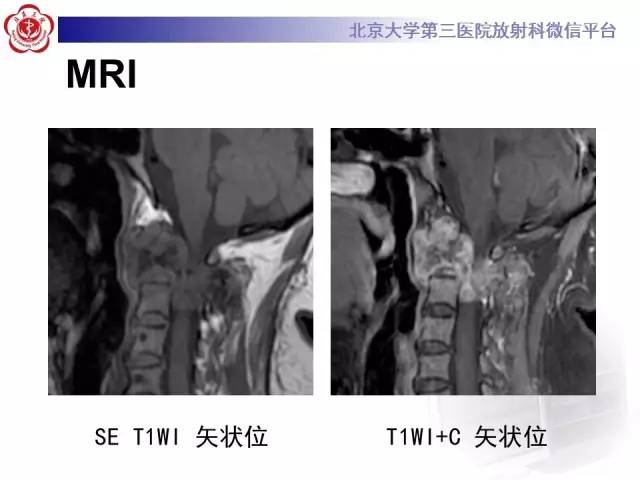 【病例】颈椎骨肉瘤1例CT及MR影像表现