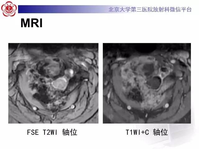 【病例】颈椎骨肉瘤1例CT及MR影像表现