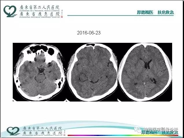 【病例】局灶性皮层发育不良FCD一例MR