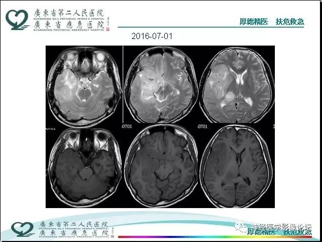 【病例】局灶性皮层发育不良FCD一例MR