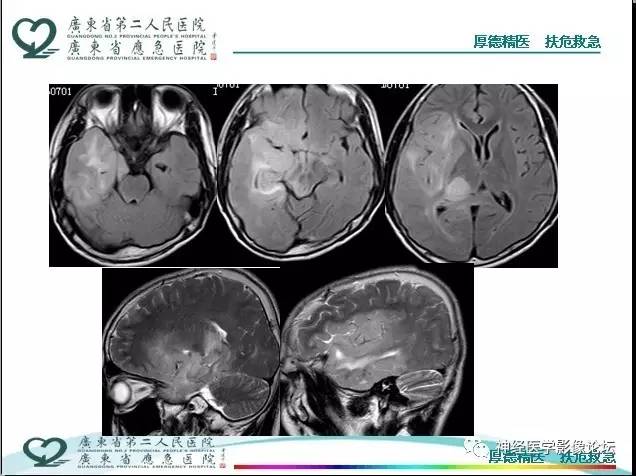 【病例】局灶性皮层发育不良FCD一例MR