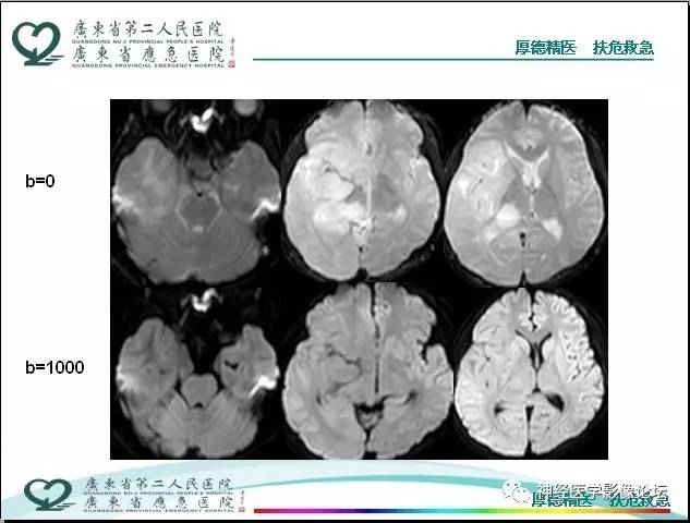 【病例】局灶性皮层发育不良FCD一例MR