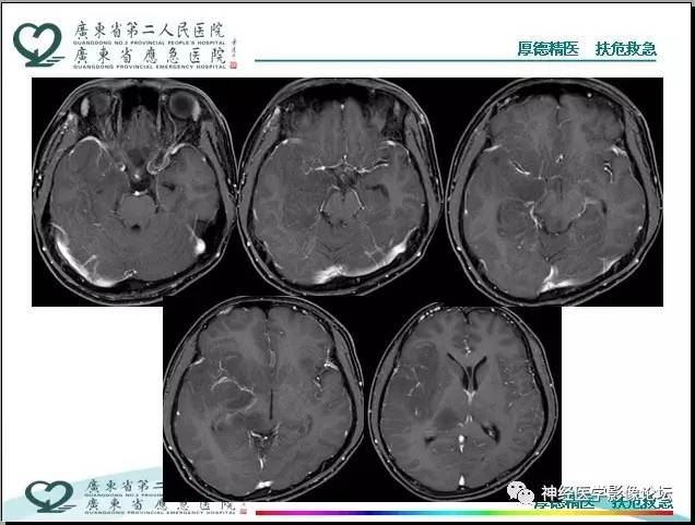 【病例】局灶性皮层发育不良FCD一例MR