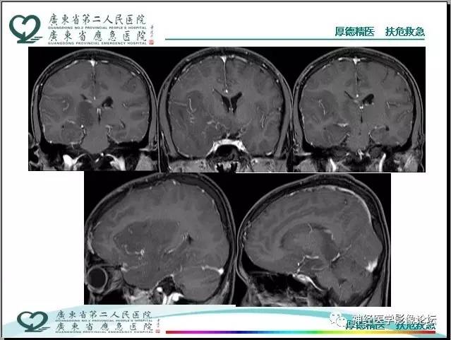 【病例】局灶性皮层发育不良FCD一例MR