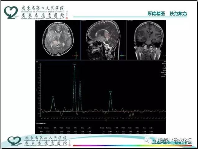 【病例】局灶性皮层发育不良FCD一例MR