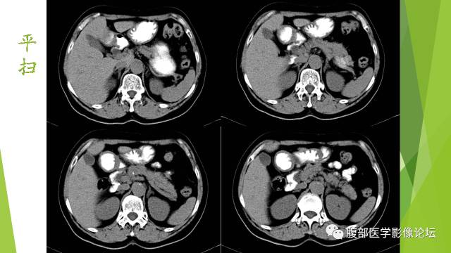 【病例】胰腺实性假乳头状瘤1例CT