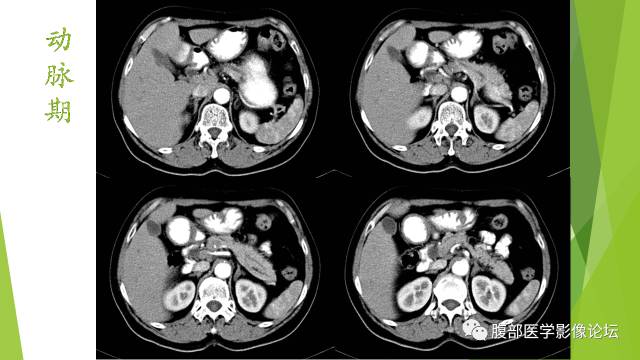【病例】胰腺实性假乳头状瘤1例CT