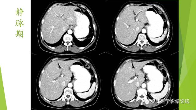 【病例】胰腺实性假乳头状瘤1例CT