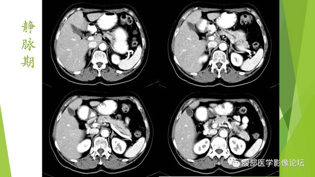 【病例】胰腺实性假乳头状瘤1例CT