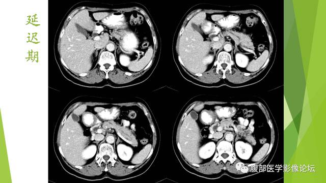 【病例】胰腺实性假乳头状瘤1例CT
