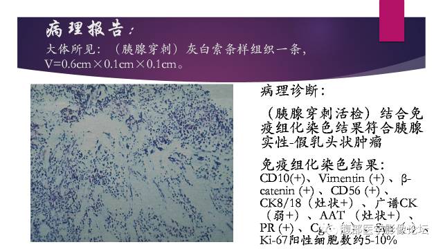 【病例】胰腺实性假乳头状瘤1例CT