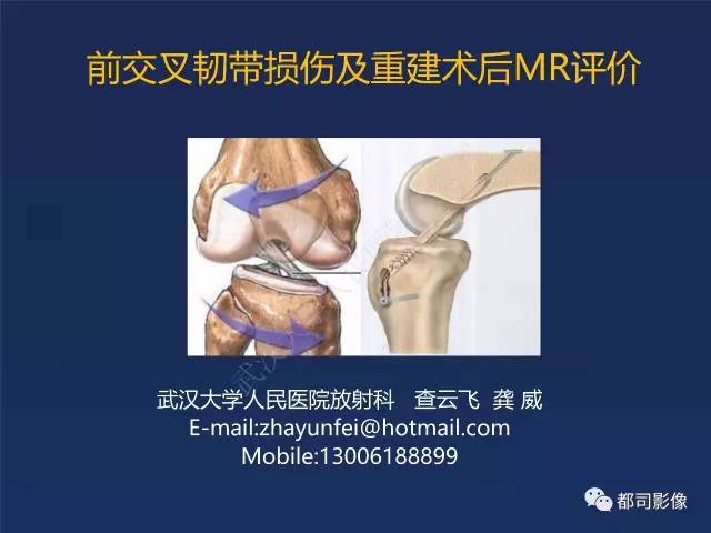 【PPT】前交叉韧带损伤及重建术后MR评价