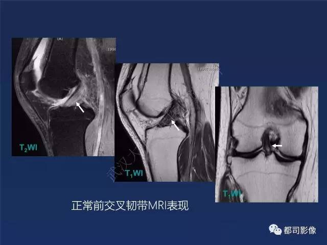 【PPT】前交叉韧带损伤及重建术后MR评价