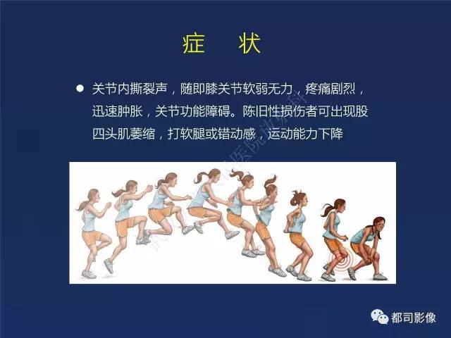 【PPT】前交叉韧带损伤及重建术后MR评价