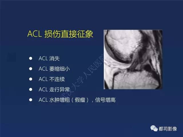 【PPT】前交叉韧带损伤及重建术后MR评价