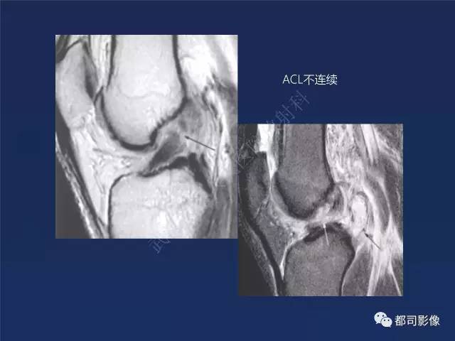 【PPT】前交叉韧带损伤及重建术后MR评价