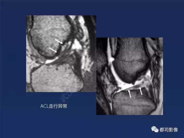 【PPT】前交叉韧带损伤及重建术后MR评价