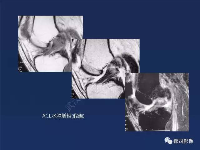 【PPT】前交叉韧带损伤及重建术后MR评价