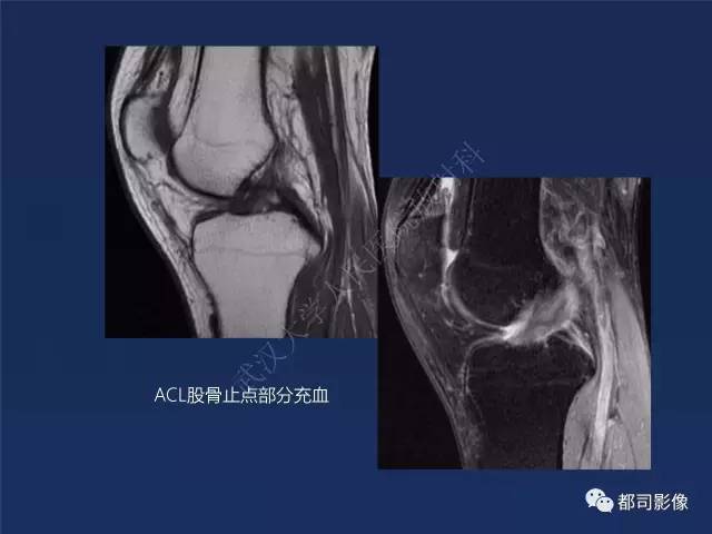 【PPT】前交叉韧带损伤及重建术后MR评价