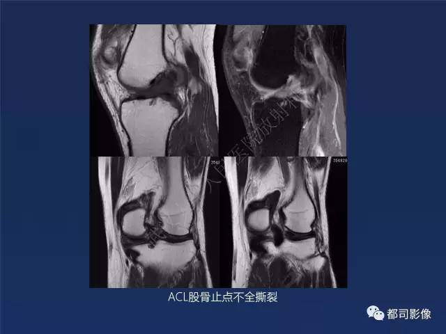 【PPT】前交叉韧带损伤及重建术后MR评价