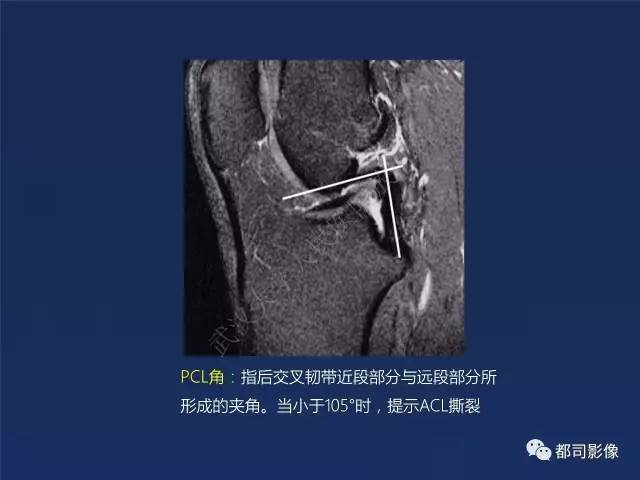 【PPT】前交叉韧带损伤及重建术后MR评价