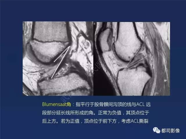 【PPT】前交叉韧带损伤及重建术后MR评价