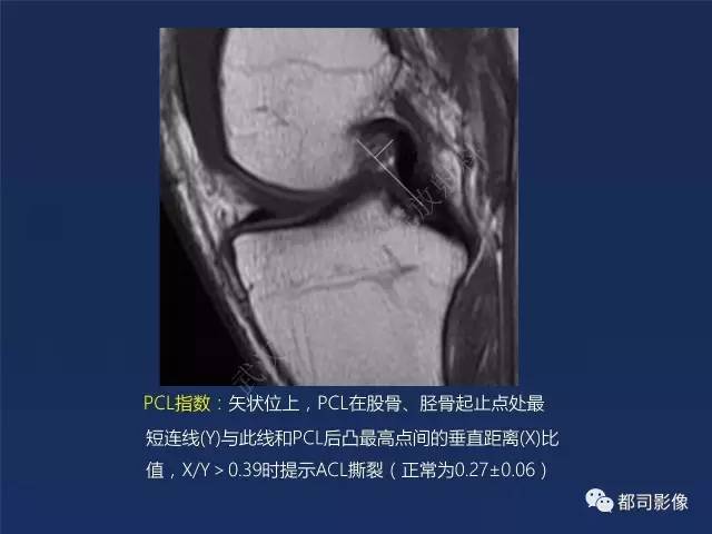【PPT】前交叉韧带损伤及重建术后MR评价