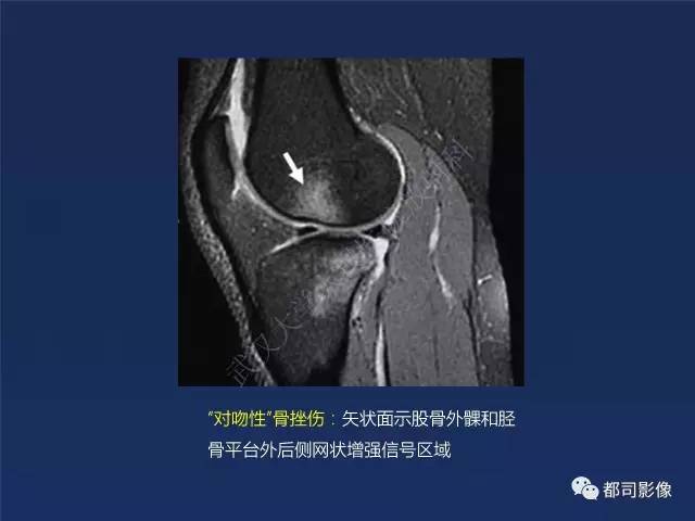 【PPT】前交叉韧带损伤及重建术后MR评价