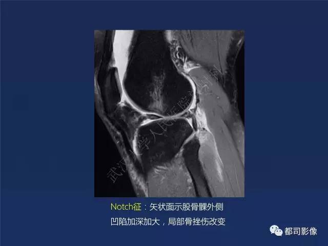 【PPT】前交叉韧带损伤及重建术后MR评价