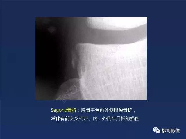 【PPT】前交叉韧带损伤及重建术后MR评价