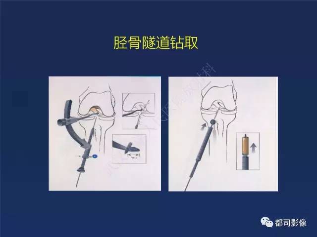【PPT】前交叉韧带损伤及重建术后MR评价