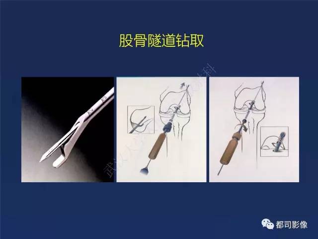 【PPT】前交叉韧带损伤及重建术后MR评价