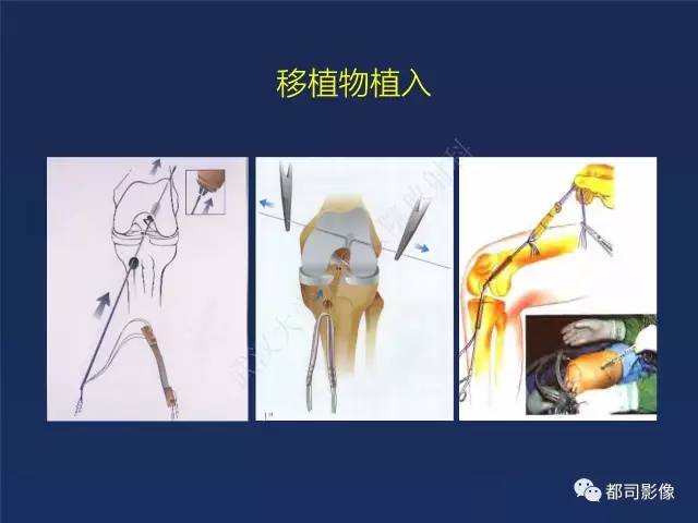 【PPT】前交叉韧带损伤及重建术后MR评价