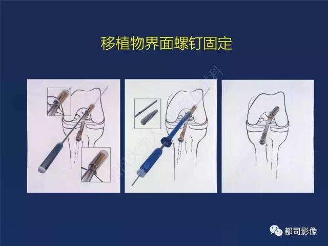 【PPT】前交叉韧带损伤及重建术后MR评价