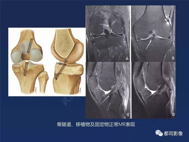 【PPT】前交叉韧带损伤及重建术后MR评价