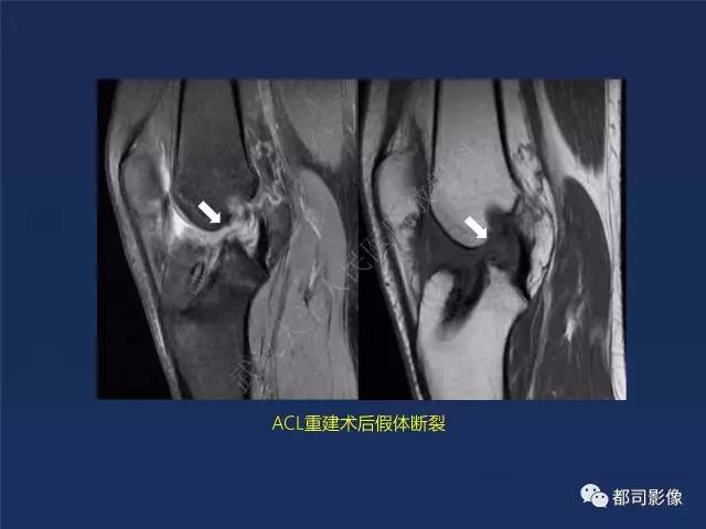 【PPT】前交叉韧带损伤及重建术后MR评价