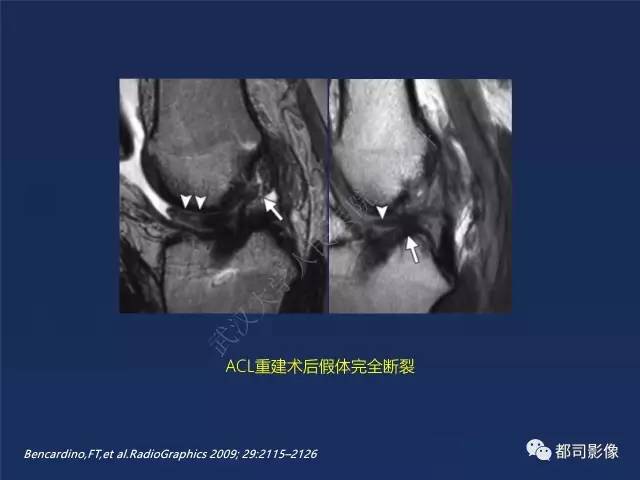 【PPT】前交叉韧带损伤及重建术后MR评价