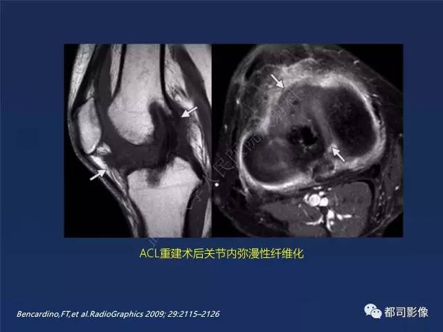【PPT】前交叉韧带损伤及重建术后MR评价