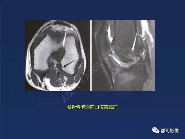 【PPT】前交叉韧带损伤及重建术后MR评价