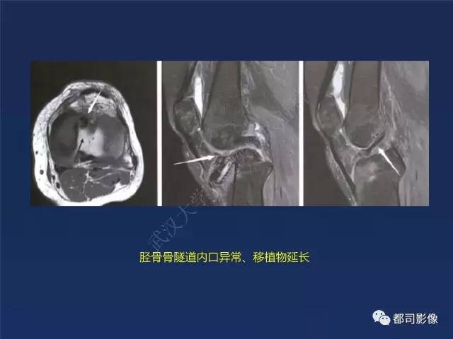 【PPT】前交叉韧带损伤及重建术后MR评价