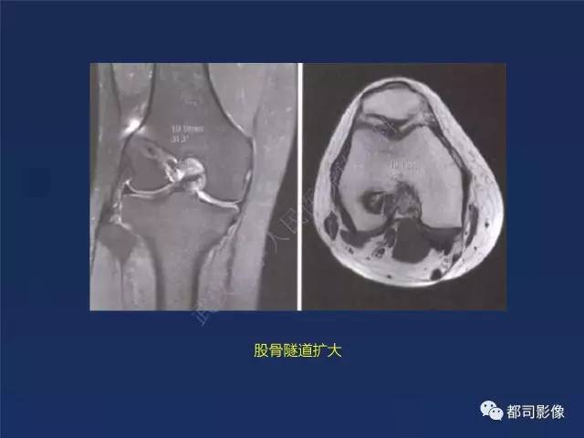 【PPT】前交叉韧带损伤及重建术后MR评价