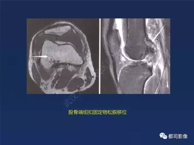 【PPT】前交叉韧带损伤及重建术后MR评价