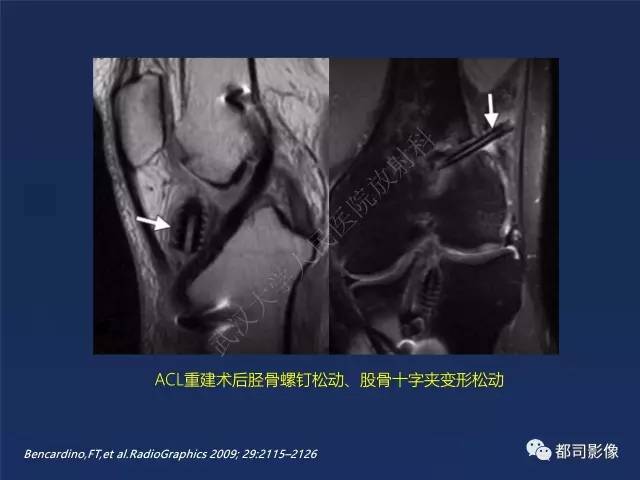【PPT】前交叉韧带损伤及重建术后MR评价