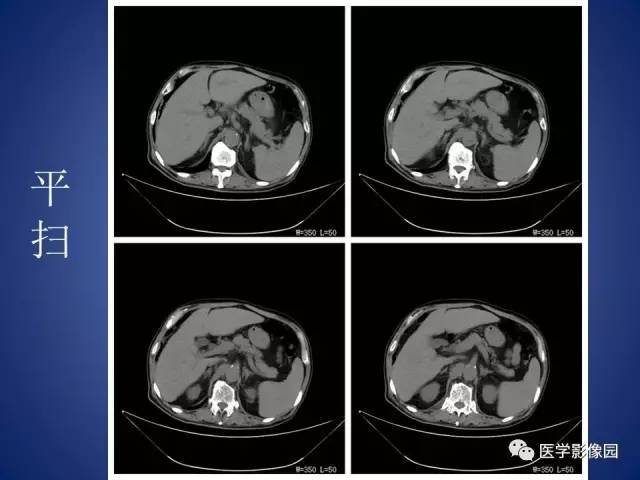 【病例】腹主动脉假性动脉瘤1例CT