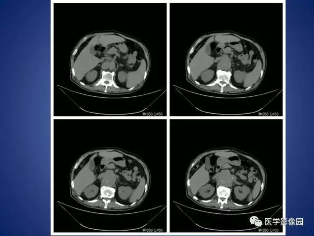 【病例】腹主动脉假性动脉瘤1例CT