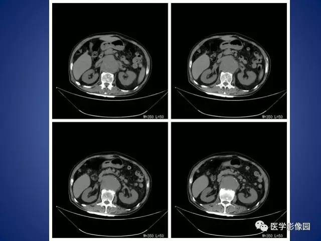 【病例】腹主动脉假性动脉瘤1例CT
