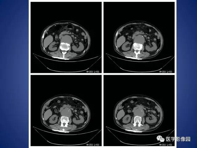 【病例】腹主动脉假性动脉瘤1例CT